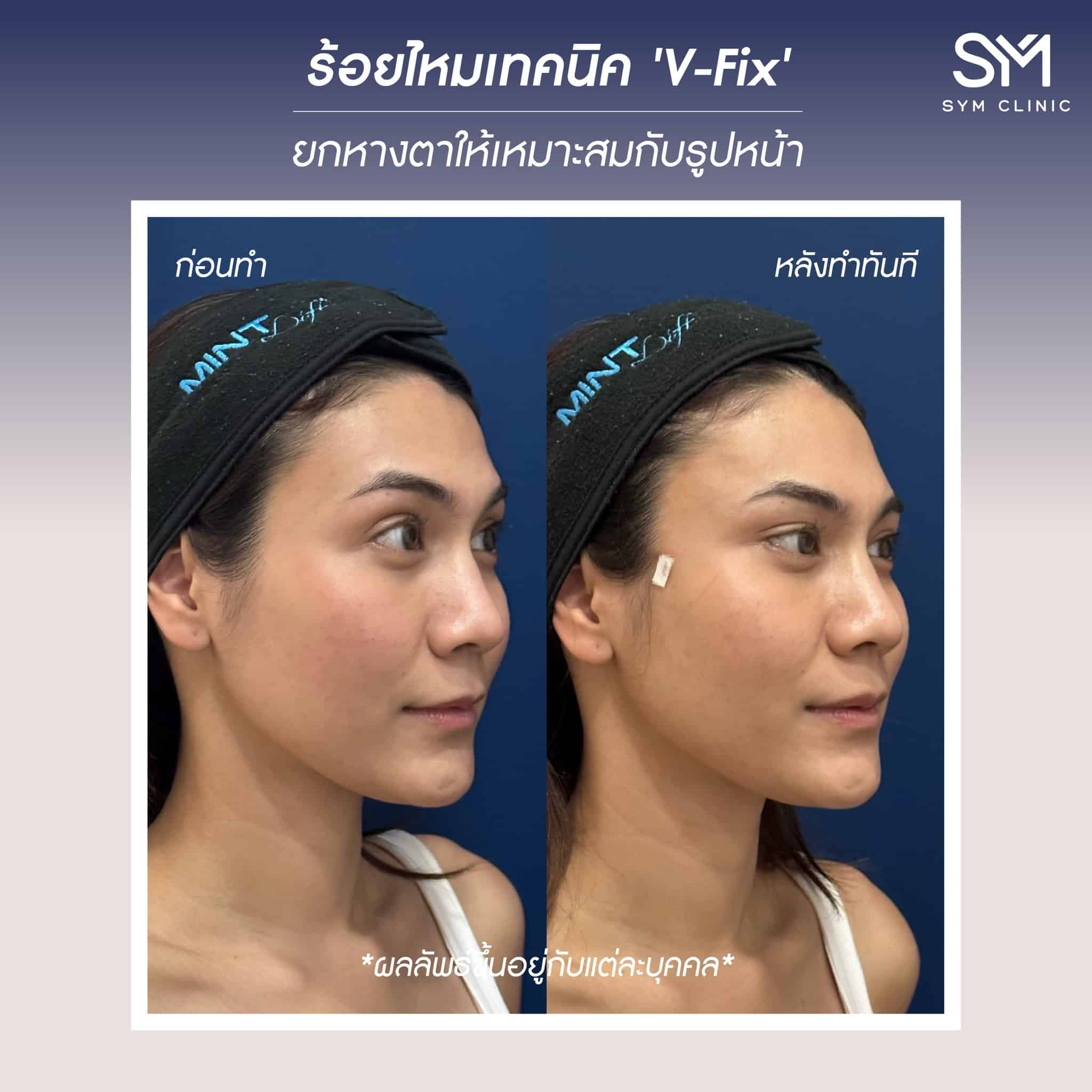 reviewร้อยไหม2